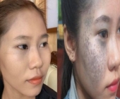 NHẬT KÍ ĐIỀU TRỊ BỚT SẮC TỐ CỦA KHÁCH HÀNG TẠI THẨM MỸ VIỆN TRÚC MAI