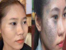 NHẬT KÍ ĐIỀU TRỊ BỚT SẮC TỐ CỦA KHÁCH HÀNG TẠI THẨM MỸ VIỆN TRÚC MAI