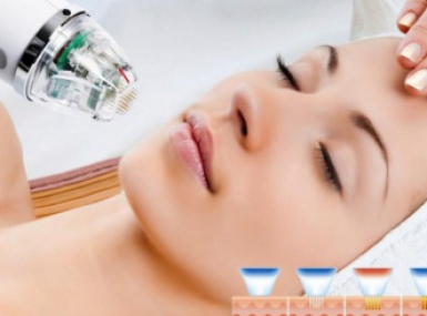 ĐIỀU TRỊ SẸO RỔ BẰNG CÔNG NGHỆ RF BENEFITS SIÊU VI ĐIỂM KẾT HỢP CÔNG NGHỆ LASER